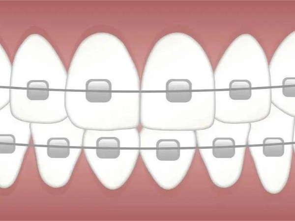 醫(yī)用牙托自動(dòng)整列|排列案例